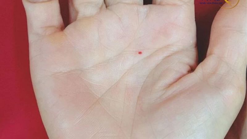 Nốt ruồi son là gì? Ý nghĩa nốt ruồi son trong nhân tướng học 6 Nốt ruồi son trong lòng bàn tay