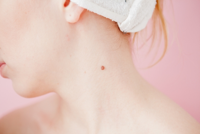 Nốt ruồi son là gì? Ý nghĩa nốt ruồi son trong nhân tướng học 7 Nốt ruồi son ở cổ